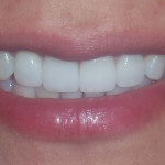 After Porcelain Veneers Treatment from We Make Smiles
