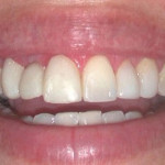 Before Teeth Whitening Treatment from We Make Smiles