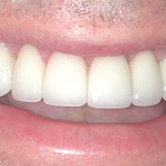 Tooth Colored Fillings: After Image