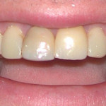 Tooth Colored Fillings: Before Image