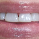 Before Teeth Treatment from We Make Smiles