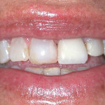 Before Dental Veneer Treatment
